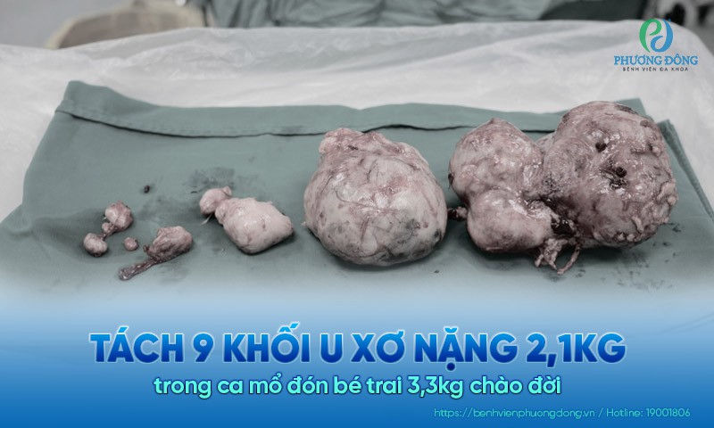 Từng đối mặt nguy cơ cắt tử cung, sản phụ đón con khỏe mạnh sau ca mổ bóc khối u xơ nặng 2,1kg