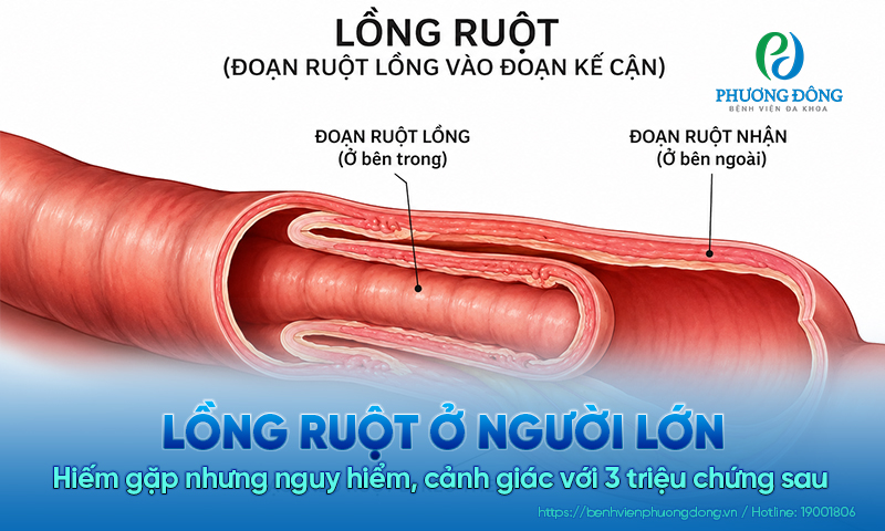 Lồng ruột ở người lớn: Hiếm gặp nhưng nguy hiểm, cảnh giác với 3 triệu chứng sau 