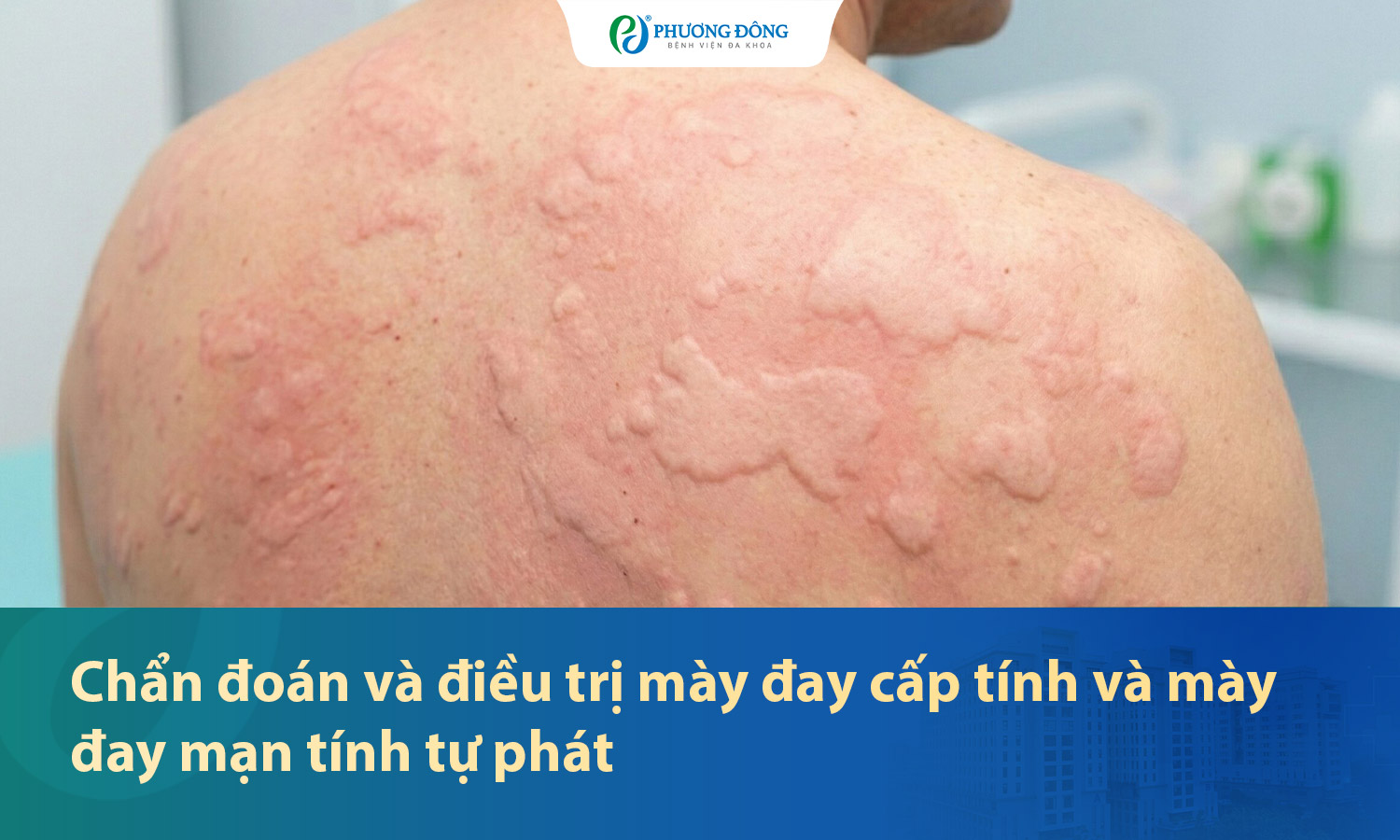 Chẩn đoán và điều trị mày đay cấp và mày đay mạn tính tự phát