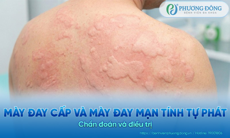 Chẩn đoán và điều trị mày đay cấp và mày đay mạn tính tự phát