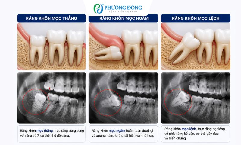 Vị trí của 3 loại răng khôn khác nhau trên phim chụp