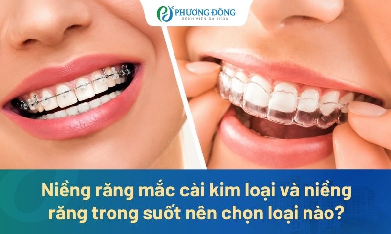 Niềng răng mắc cài kim loại và niềng răng trong suốt nên chọn loại nào?