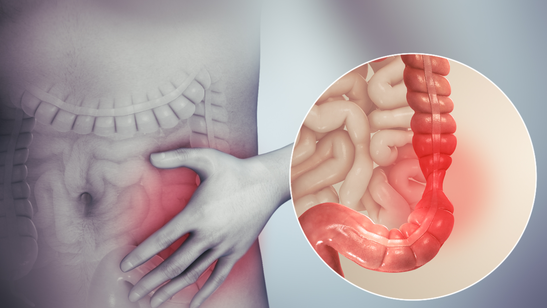 Hội chứng ruột kích thích: Bệnh thật, không phải “do nghĩ nhiều”
