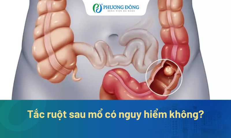 Tắc ruột sau mổ có nguy hiểm không? Dấu hiệu nào cần đi viện ngay?