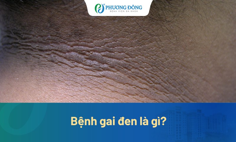 Gai đen là gì? Phẫu thuật giảm cân có cải thiện gai đen không?