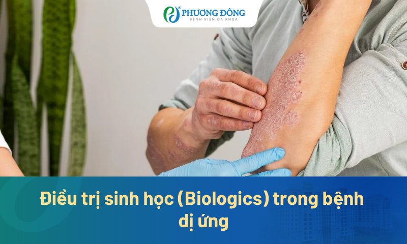 Điều trị sinh học (Biologics) trong bệnh dị ứng: Bước ngoặt thay đổi cách tiếp cận viêm type 2
