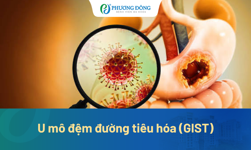 U mô đệm đường tiêu hóa (GIST): Khi nào chỉ cần theo dõi hay điều trị? 