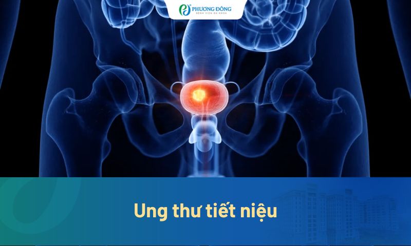 Ung thư tiết niệu: Triệu chứng, nguyên nhân và cách điều trị