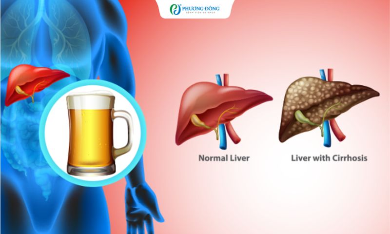 Hình ảnh gan tổn thương do bia rượu