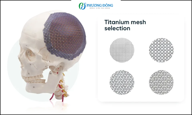 Ghép sọ bằng lưới titanium có thành công không?