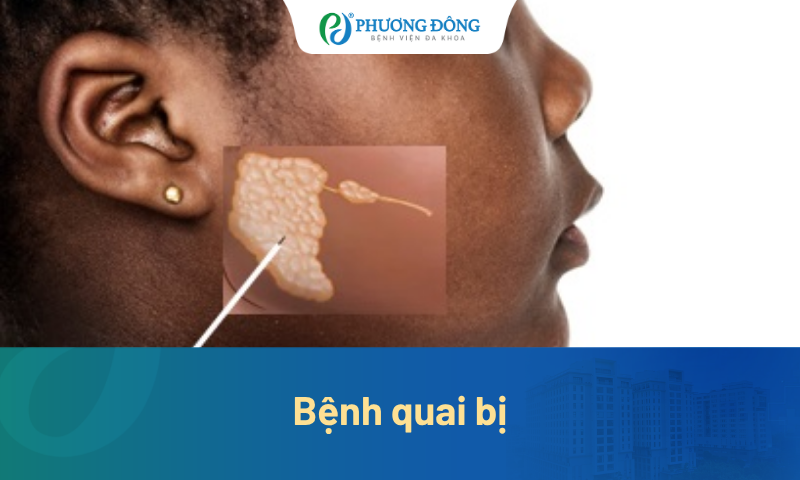 Bệnh quai bị có thực sự lành tính? Chia sẻ góc nhìn từ chuyên gia y tế