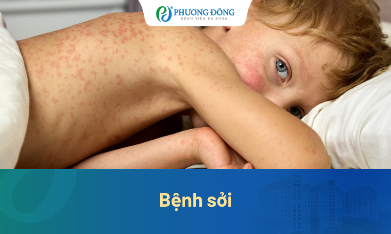 Cảnh báo về bệnh Sởi: Dấu hiệu và cách phòng ngừa an toàn