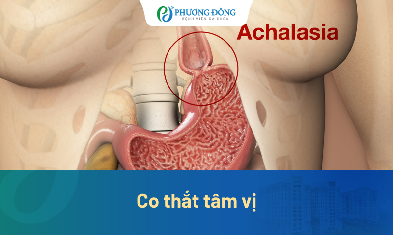 Co thắt tâm vị: 5 dấu hiệu cảnh báo không nên tiếp tục bỏ qua