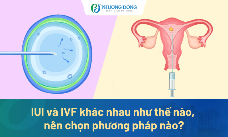 IUI và IVF khác nhau như thế nào, nên chọn phương pháp nào?