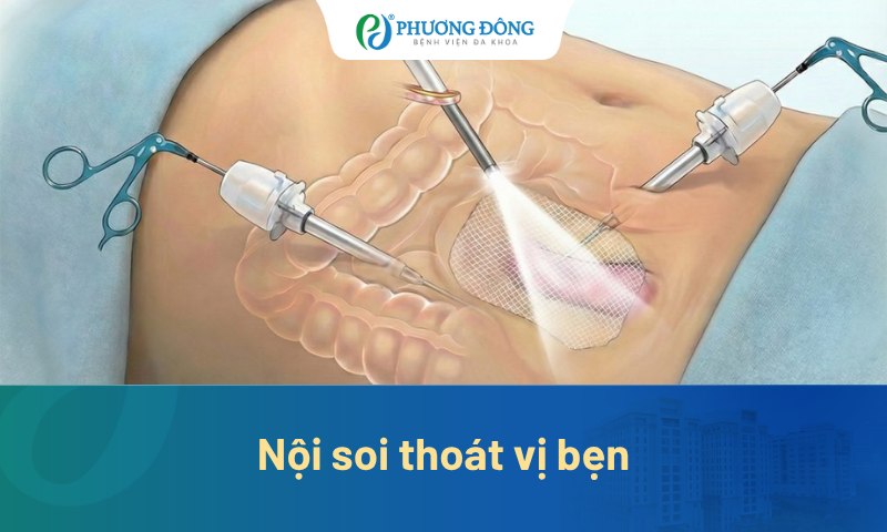 Nội soi thoát vị bẹn: Ít đau hơn, hồi phục nhanh hơn có đúng không? 