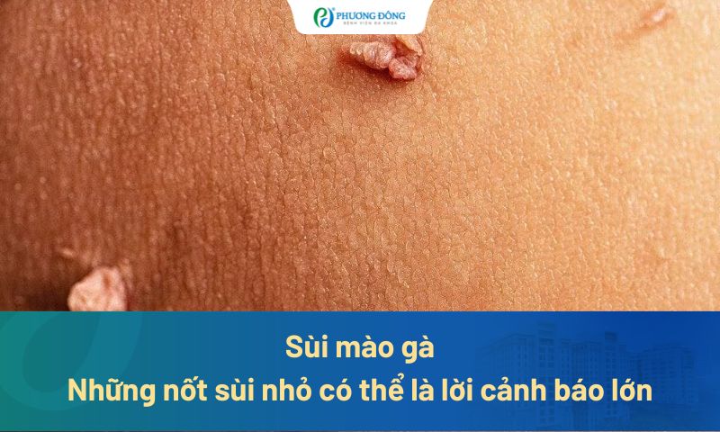 Sùi mào gà: Những nốt sùi nhỏ có thể là lời cảnh báo lớn