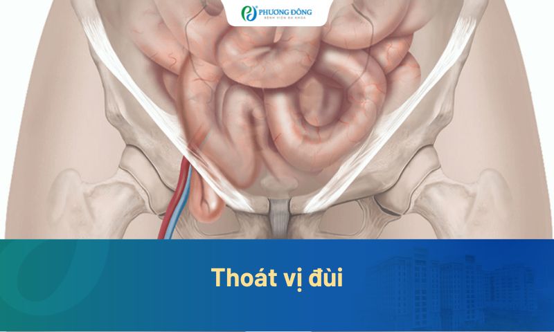 Thoát vị đùi: Cách nhận biết sớm, điều trị an toàn và hạn chế tái phát