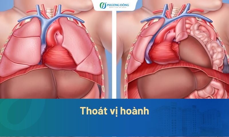 Thoát vị hoành: Nguyên nhân, mức độ nguy hiểm và cách điều trị