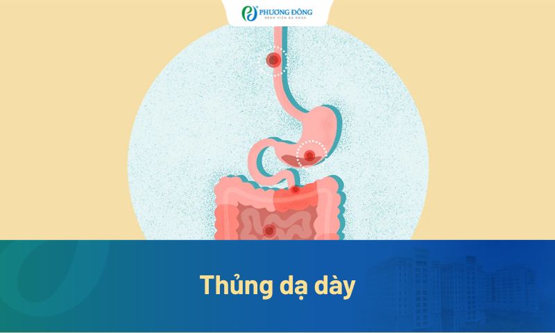 Thủng dạ dày: Dấu hiệu cảnh báo sớm, nguyên nhân và điều trị