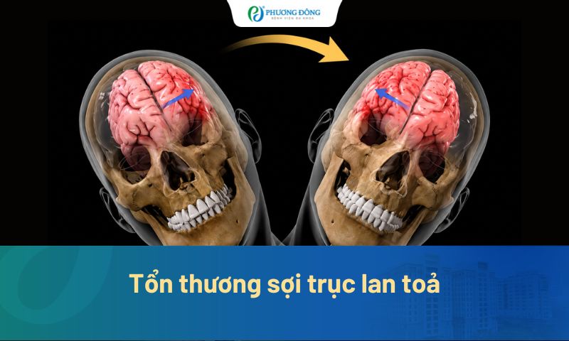 Tổn thương sợi trục lan tỏa: Dấu hiệu, nguyên nhân và cách điều trị