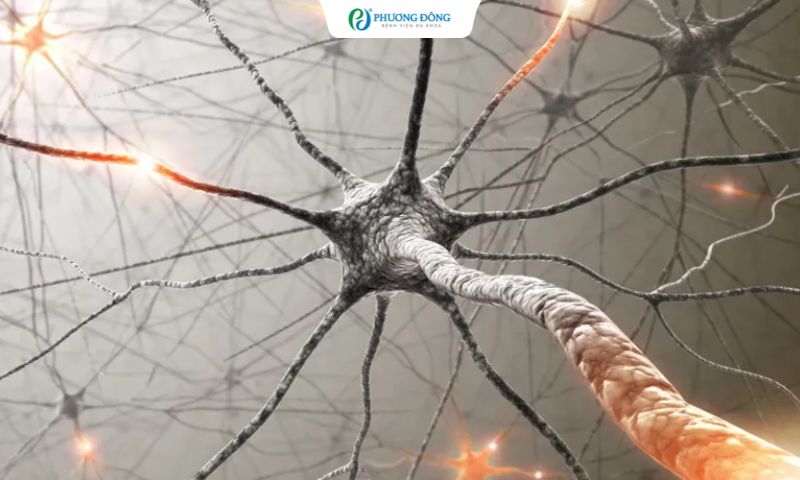 Tổn thương sợi trục lan tỏa gây tổn thương hệ thống kết nối bên trong não ngay cả khi không chảy máu