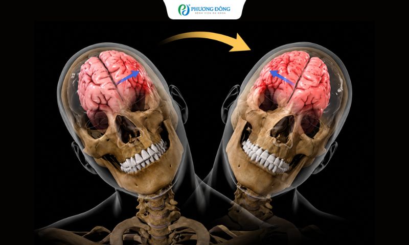 Cơ chế gây tổn thương sợi trục lan toả thường liên quan đến lực xoay mạnh hoặc đột ngột do tai nạn giao thông