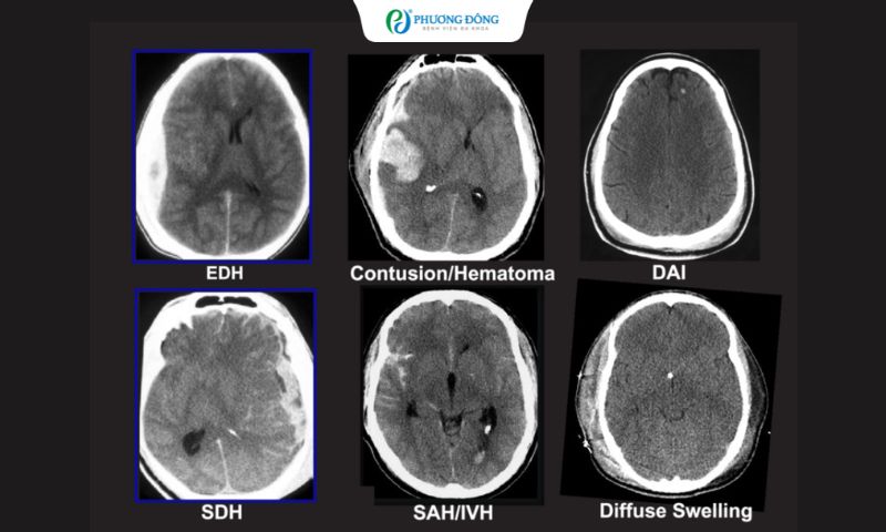Hình ảnh CT khó phát hiện tổn thương sợi trục lan toả