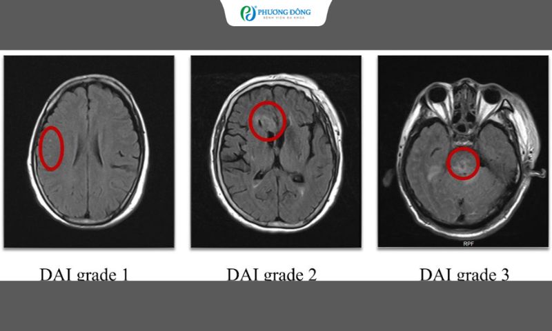 Hình ảnh MRI cho thấy các dấu hiệu đặc trưng của DAI
