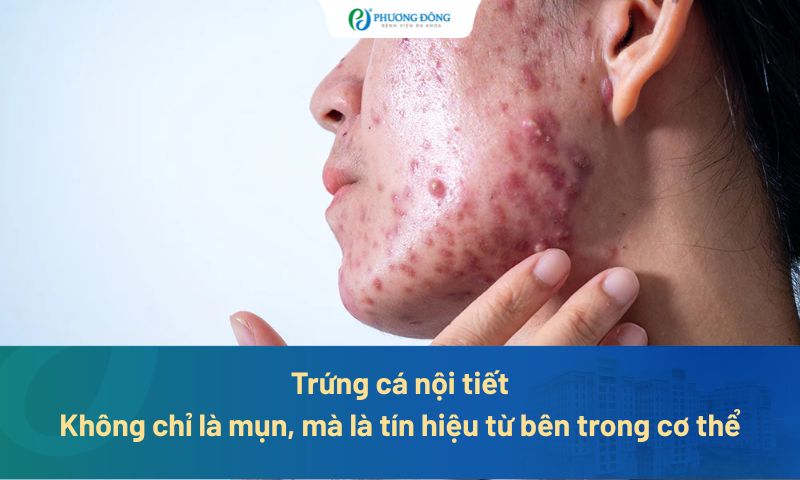 Trứng cá nội tiết: Không chỉ là mụn, mà là tín hiệu từ bên trong cơ thể