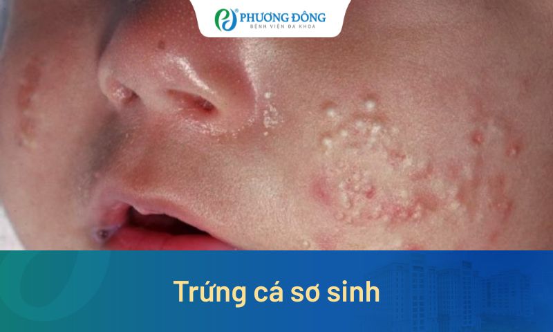 Trứng cá sơ sinh: Nguyên nhân, dấu hiệu và cách chăm sóc đúng