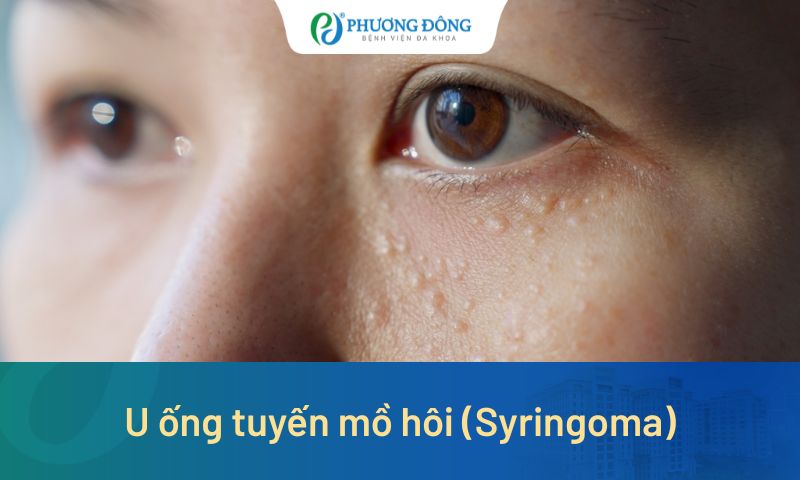 U Ống Tuyến Mồ Hôi (Syringoma): Có Nguy Hiểm Không Và Cách Trị Hiệu Quả
