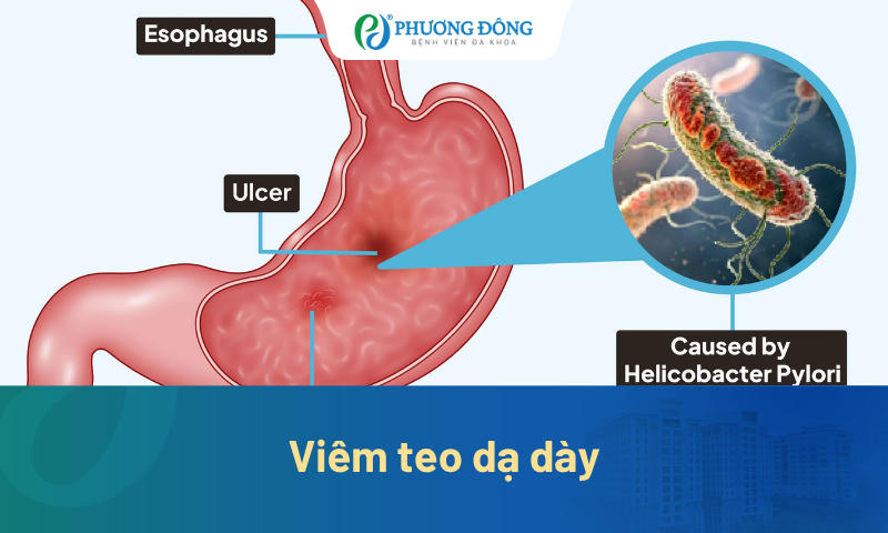 Viêm teo dạ dày có chữa được không? Góc nhìn từ bác sĩ chuyên khoa 