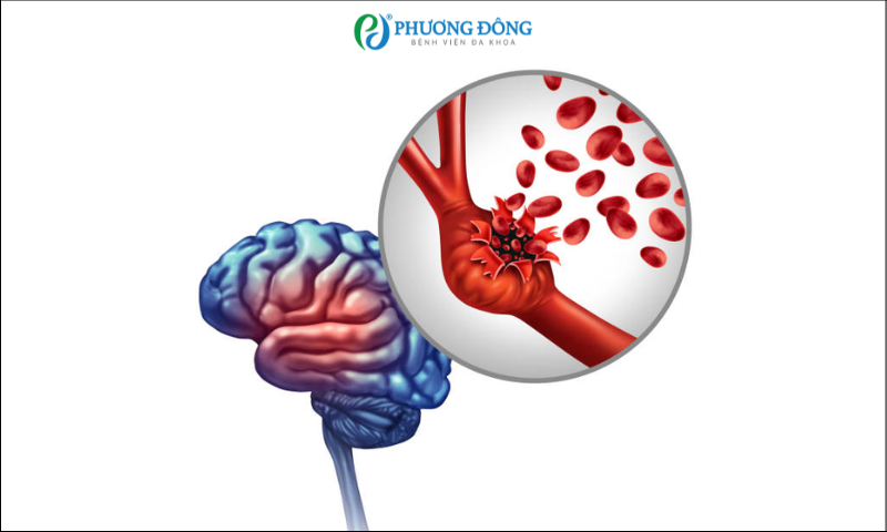Bị ngã xe có nguy cơ tụ máu não không?