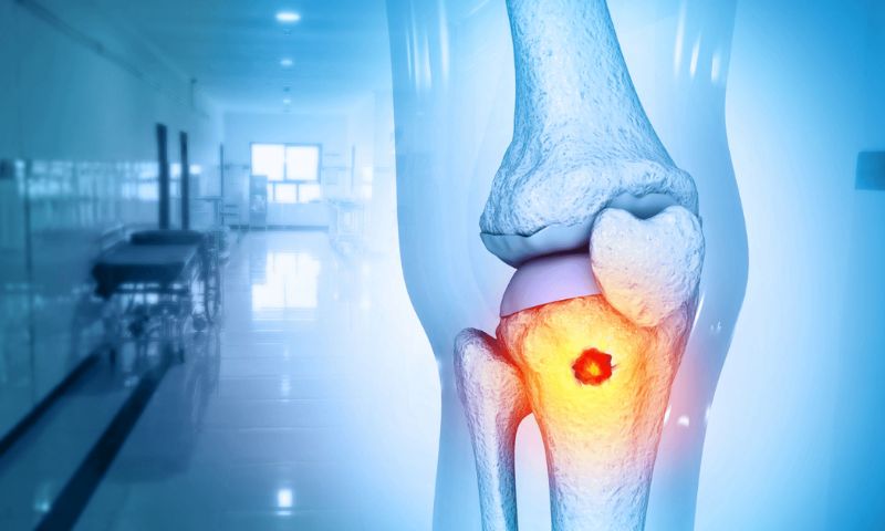 Hỏi - đáp với bác sĩ Ung bướu: Di căn xương có điều trị được không?