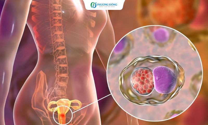 Ung thư cổ tử cung đã hoá trị và cắt triệt căn có tái phát không?