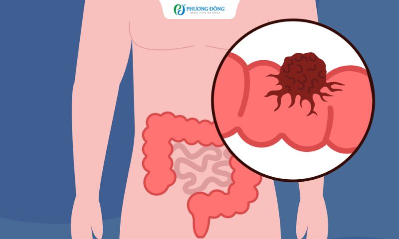 Hỏi - Đáp với bác sĩ Ung bướu: Ung thư đại tràng sống được lâu không?