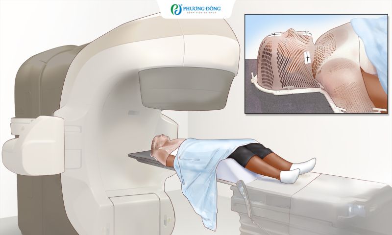 Hỏi - đáp với bác sĩ: Ung thư hạ họng hoá xạ trí sống được bao lâu?