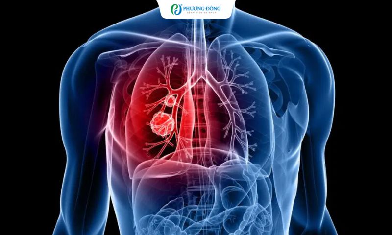 Ung thư phổi giai đoạn cuối điều trị thế nào khi không có đột biến gen?