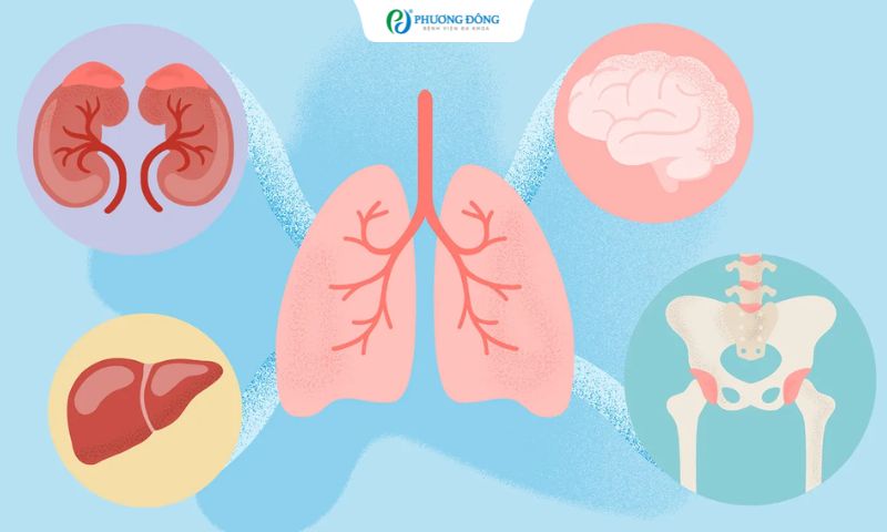 Ung thư phổi giai đoạn IV di căn xương, tuyến thượng thận và lách điều trị thế nào?