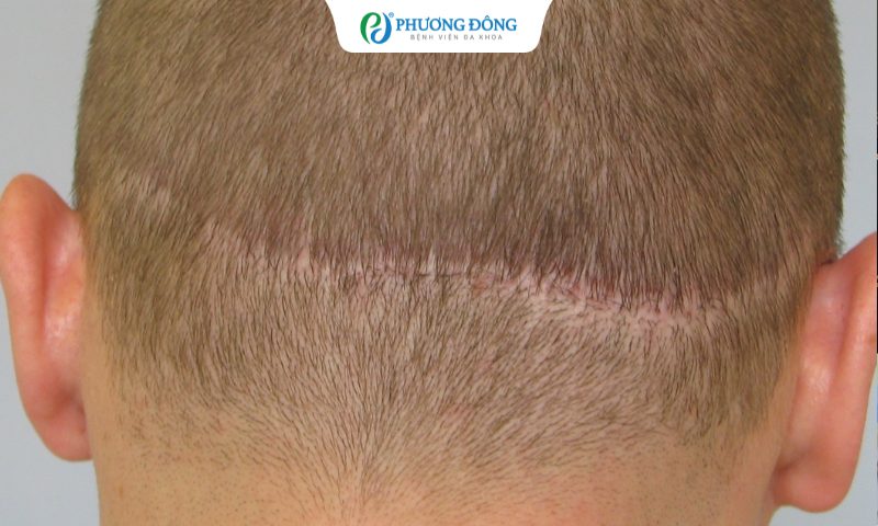 Vết khâu ở đầu đau âm ỉ nhiều năm có nguy hiểm không?