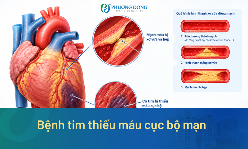 Bệnh tim thiếu máu cục bộ mạn: Triệu chứng và cách điều trị 