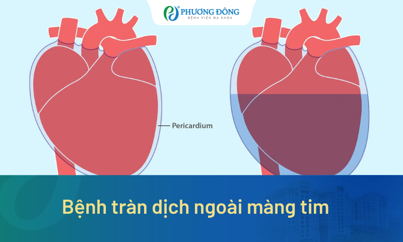 Bệnh tràn dịch ngoài màng tim có nguy hiểm không? Triệu chứng nhận biết 