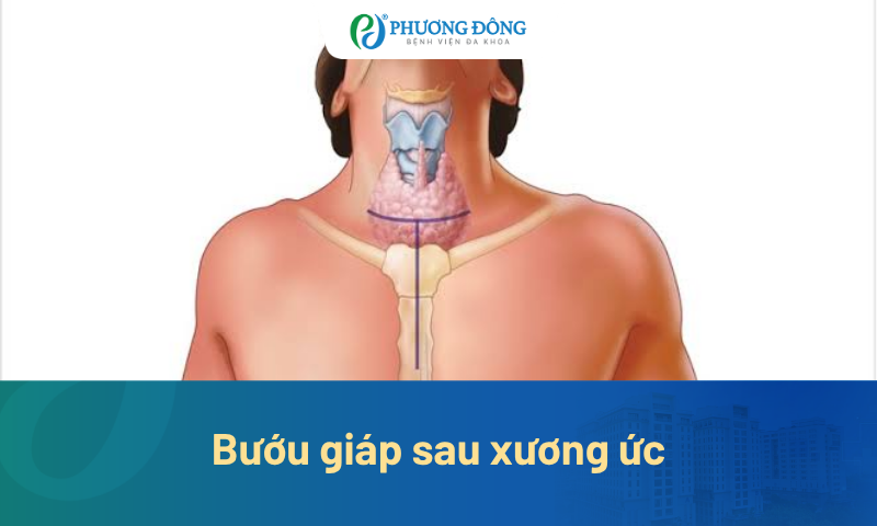 Bướu giáp sau xương ức: Dấu hiệu nhận biết và hướng điều trị chuẩn y khoa