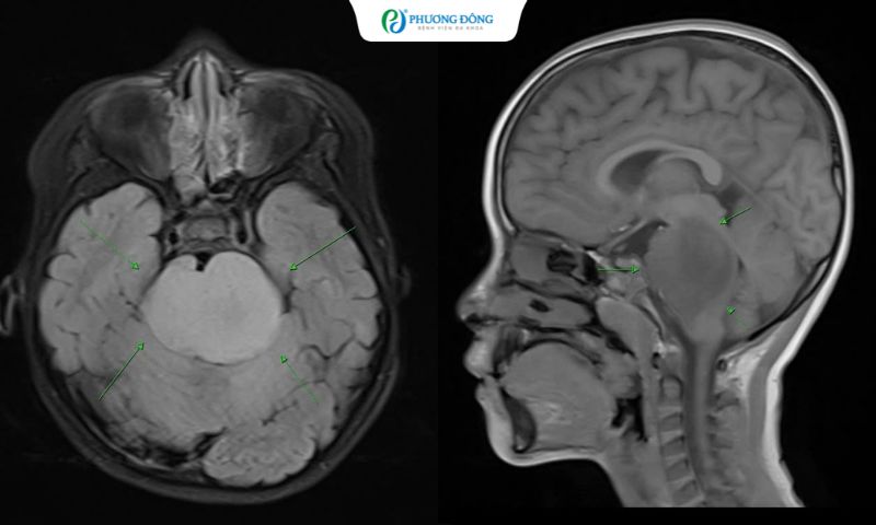 Lác mắt, méo miệng kéo dài 4 tháng, bé gái 7 tuổi phát hiện u thân não