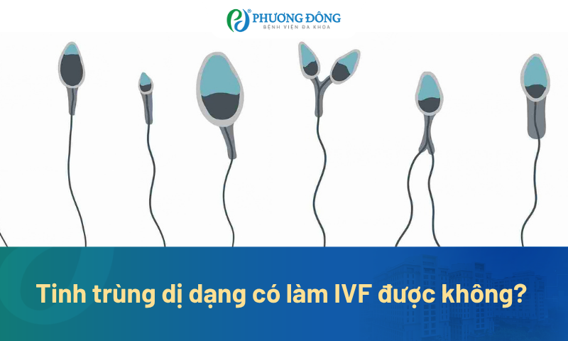 Tinh trùng dị dạng có làm IVF được không? Khi nào cần ICSI?