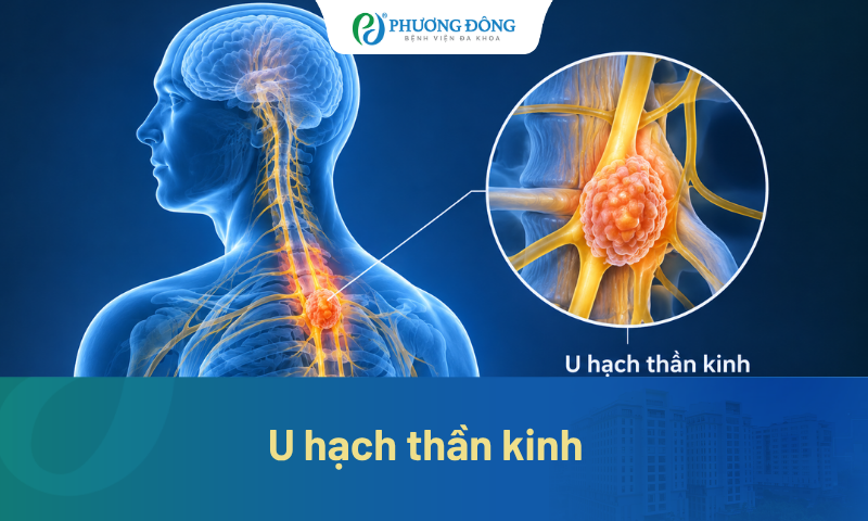 U hạch thần kinh là gì? Vì sao không nên chủ quan với khối u lành tính?