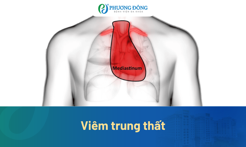 Viêm trung thất: Vì sao phát hiện muộn có thể đe dọa tính mạng?