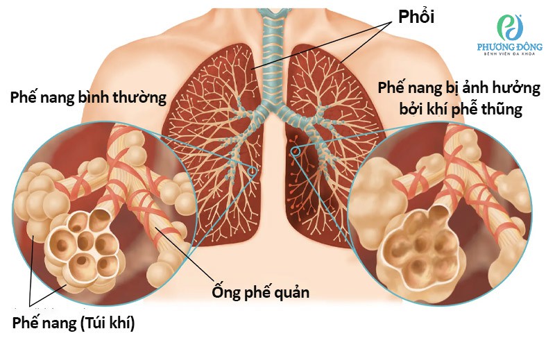 Hiện chưa có phương pháp chữa trị hoàn toàn cho bệnh khí phế thũng, nhưng có nhiều biện pháp điều trị có thể giúp kiểm soát triệu chứng của bệnh