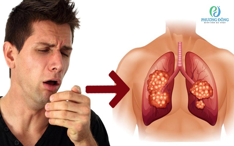 Bệnh xơ phổi không phải là một bệnh lây nhiễm