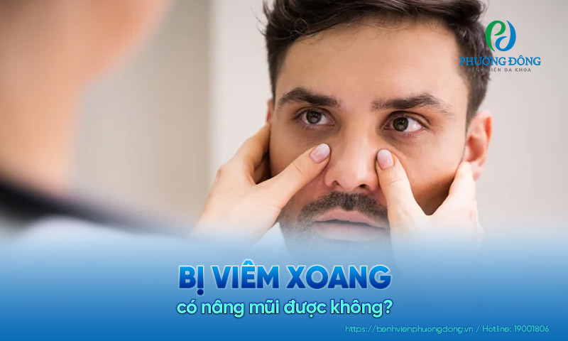 Người bị viêm xoang có nâng mũi được không?